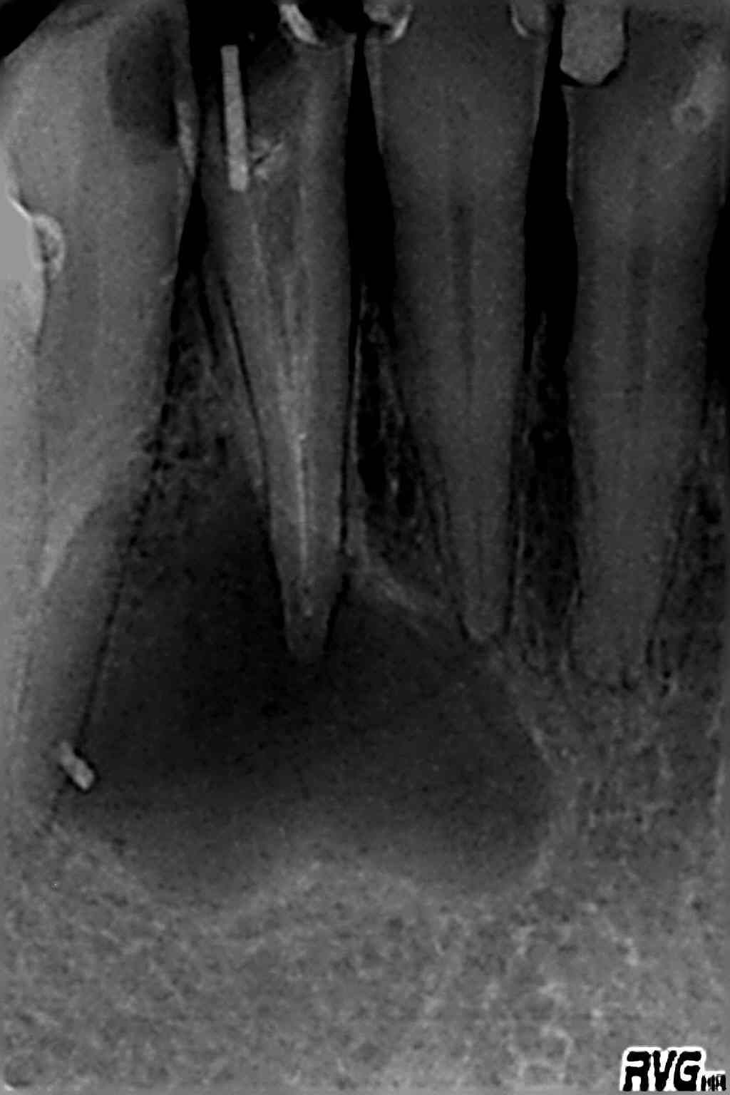 Kilkenny Endodontics Root Canal Dentist In Ireland